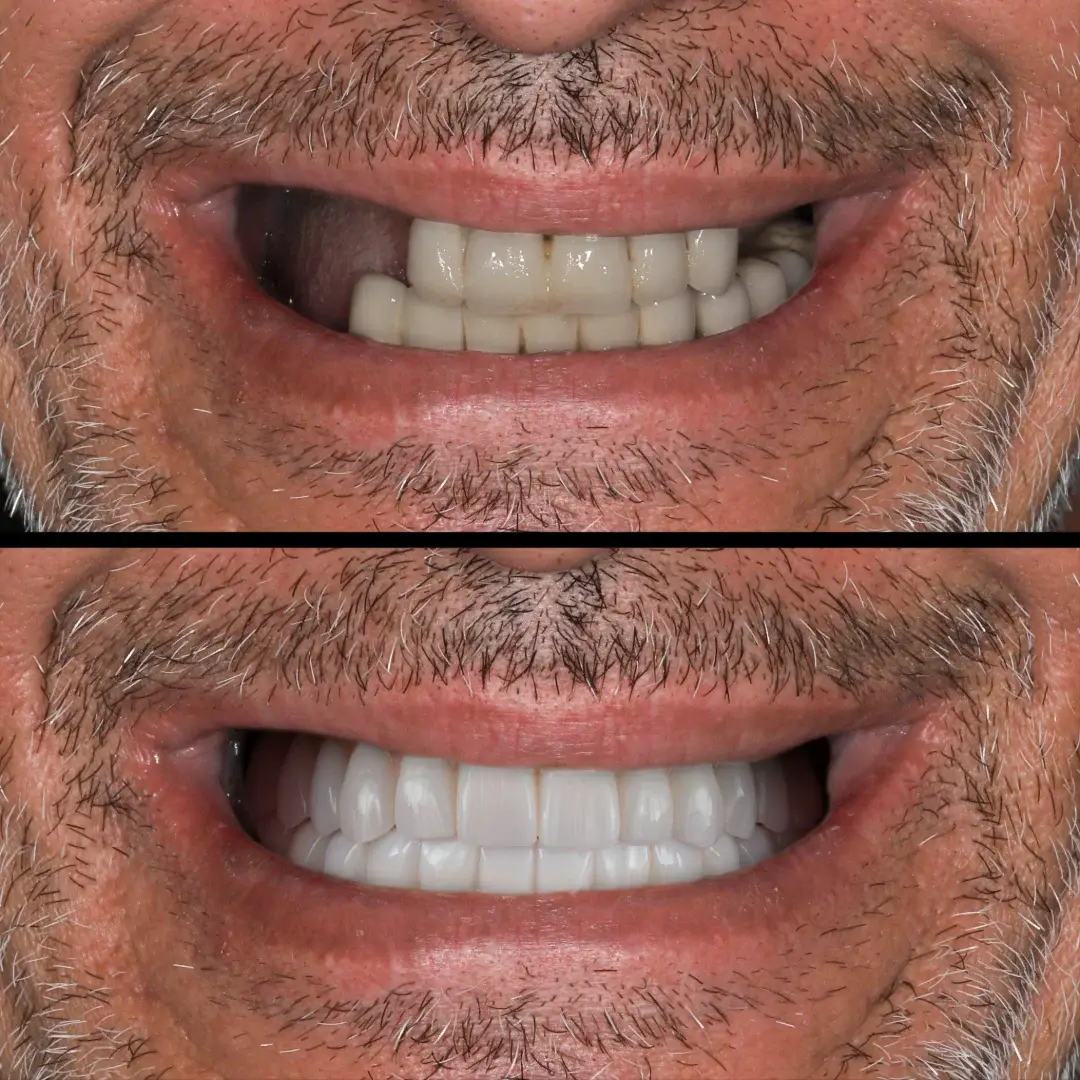 All-on-4 Dental Implants in Sydney