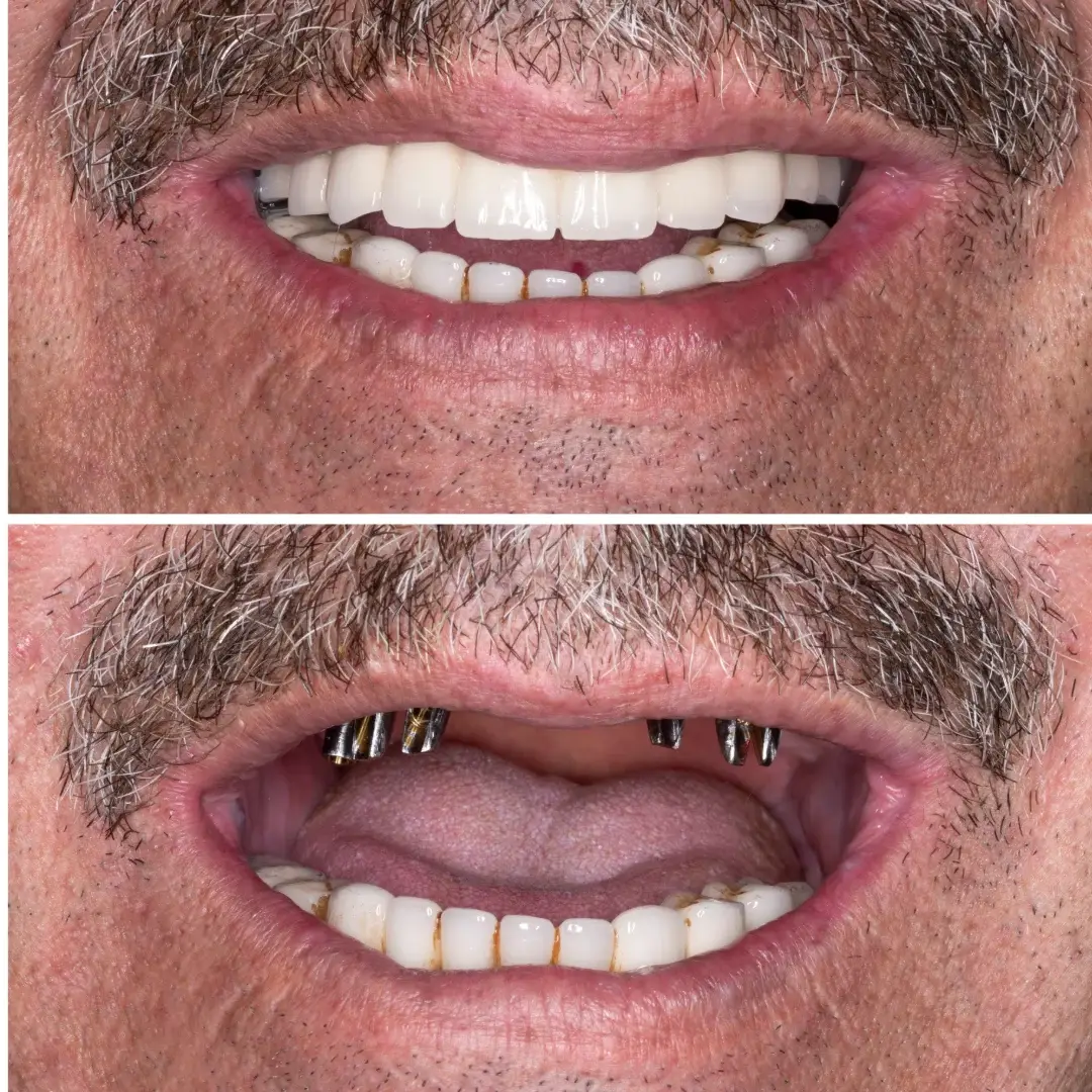 All-on-4 Dental Implants in Sydney