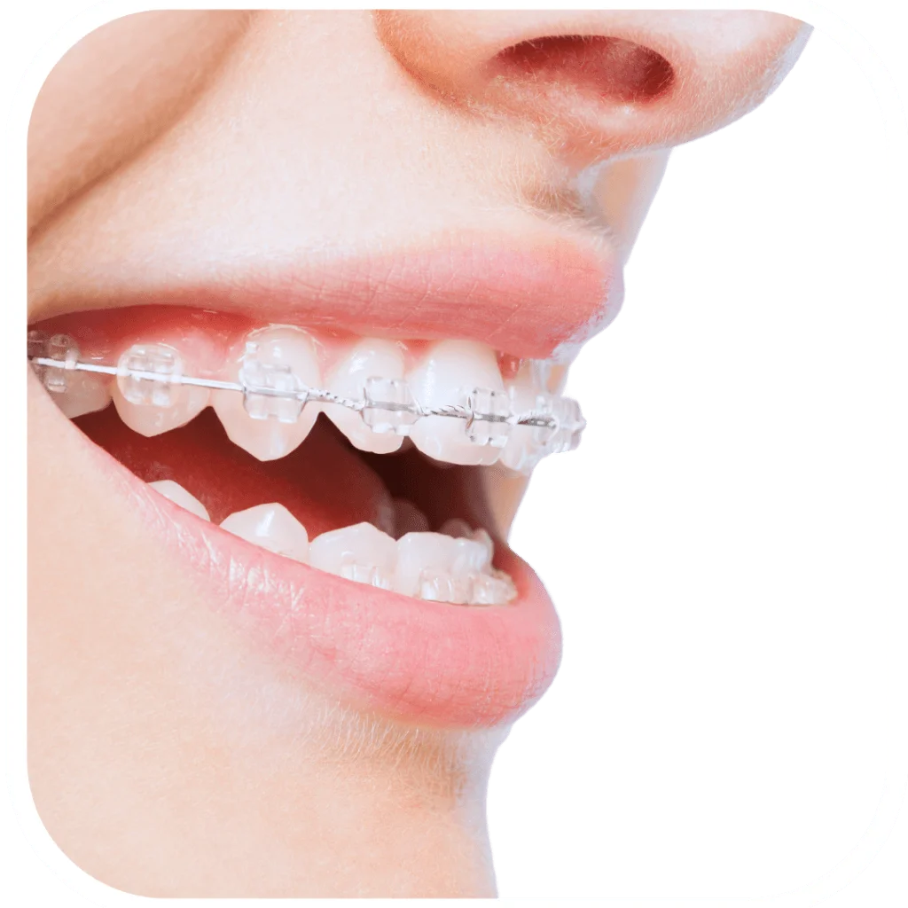 clear orthodontics sydney