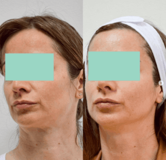 Facelift results in Belgrade — before-and-after jawline definition