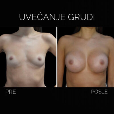 Adonis Hospital breast augmentation front view patient 2