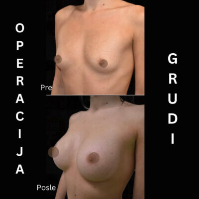 Adonis hospital anatomic implants before after photo front view natural look