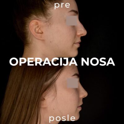adonis hospital piezo rhinoplasty before after photo female patient