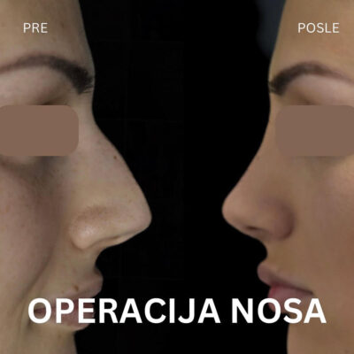 adonis hospital open nose correction before after photo