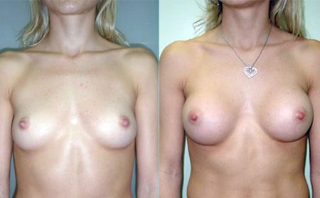 breast augmentation before after – patient 3-1, submuscular implants