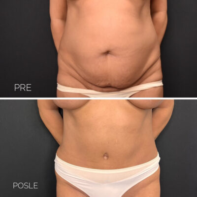Adonis hospital abdominoplasty before after photos front view