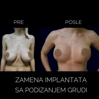 Adonis hospital breast replacement with breast lifting before after photo