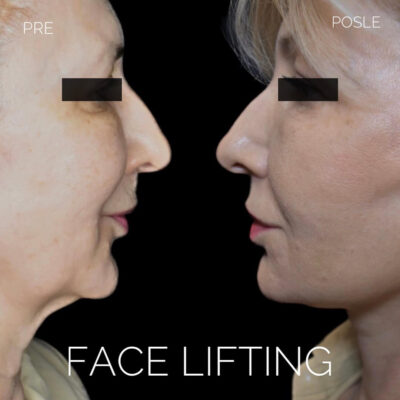 Adonis hospital facelift mid age lady before after photo