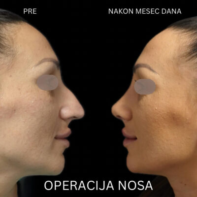 adonis hospital nose correction before after photo