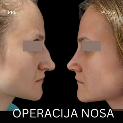 adonis hospital nose job with septoplasty