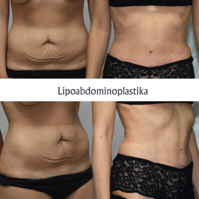 Plastic Surgery Dr Maljkovic Liposuction and abdominoplasty Serbia before after photos