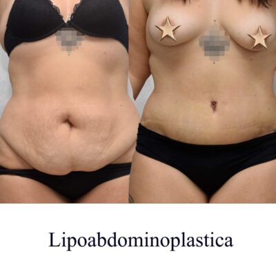 Plastic Surgery Dr Maljkovic Lipoabdominoplasty Belgrade before after photos - front view