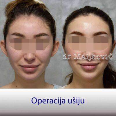Plastic Surgery Dr Maljkovic ear correction Serbia before after photos- front side view