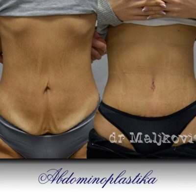 Plastic Surgery Dr Maljkovic Abdominoplasty Serbia procedure before after photos- front view