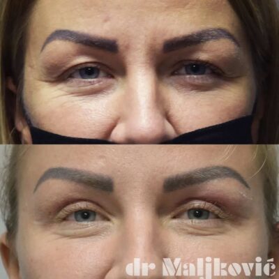Plastic Surgery Dr Maljkovic female patient 33 years old eyelid surgery before after photos - front view complete opened eyes