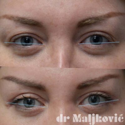 Plastic Surgery Dr Maljkovic female patient under 40 upper eyelid surgery before after photos - front view complete detailed