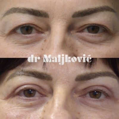 Plastic Surgery Dr Maljkovic Upper Blepharoplasty Belgrade before after photos - front view complete