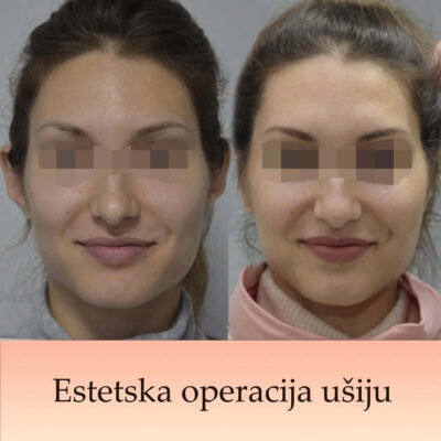 Plastic Surgery Dr Maljkovic female ear correction Belgrade - front side view