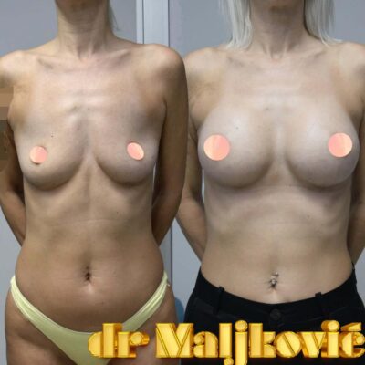Plastic Surgery Dr Maljkovic Breast Augmentation Anatomical implants 485cc before after perfect look 40+ years lady- front view