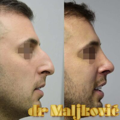 Plastic Surgery Dr Maljkovic male patient nose correction procedure before after photos - side view