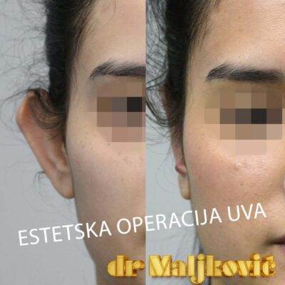 Plastic Surgery Dr Maljkovic female single ear correction procedure before after photos - front view