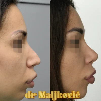 Plastic Surgery Dr Maljkovic female patient secondary rhinoplasty procedure before after photos - side view