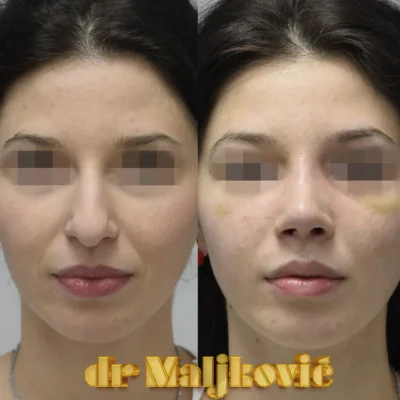 Plastic Surgery Dr Maljkovic female nose surgery before after photos - front view