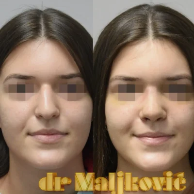 Plastic Surgery Dr Maljkovic female piezo rhinoplasty before after photos - front view