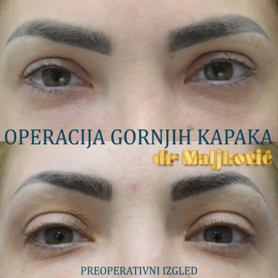 Plastic Surgery Dr Maljkovic Upper Eyelid surgery Belgrade before after photos - front view complete