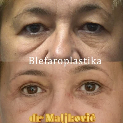 Plastic Surgery Dr Maljkovic Blepharoplasty Serbia before after photos - front view complete