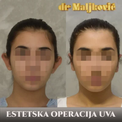 Plastic Surgery Dr Maljkovic female otoplasty procedure before after photos - front view