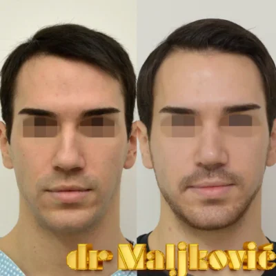 Plastic Surgery Dr Maljkovic male open septorhinoplasty before after photos - front view