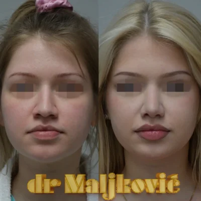 Plastic Surgery Dr Maljkovic close rhinoplasty before after photos - front view