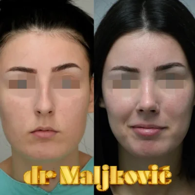 Plastic Surgery Dr Maljkovic close nose correction before after photos - front view