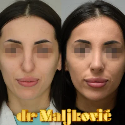 Plastic Surgery Dr Maljkovic open secondary rhinoplasty procedure before after photos - front view