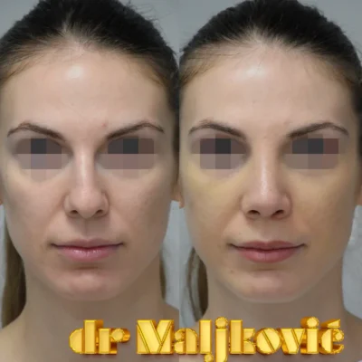 Plastic Surgery Dr Maljkovic Rhinoplasty procedure before after photos - front view