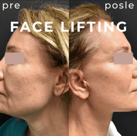 Nationwide network of facelift surgeons Before-and-after facelift results in Serbia, 2025
