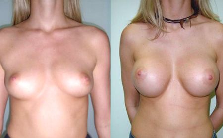 breast augmentation before - after – patient 2-2, belgrade clinic