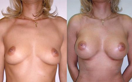 mentor implant augmentation before after – patient 5-2, belgrade serbia