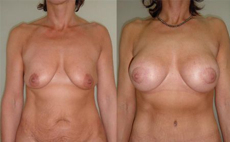 breast lift before - after – patient 2-1, belgrade clinic