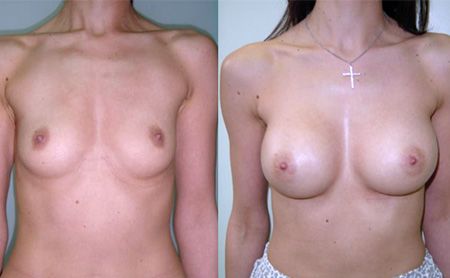 mentor implant augmentation before after – patient 7, belgrade serbia