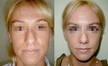 rhinoplasty before after – patient 1-1, belgrade serbia