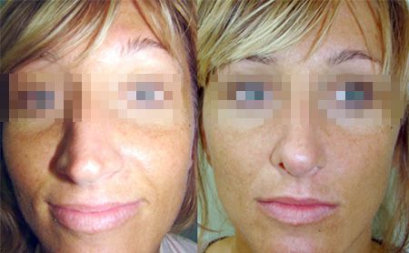 rhinoplasty before after – patient 2-1, 6 weeks post-op
