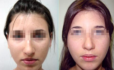 open rhinoplasty pre-post-op – patient 3-1, deviated septum