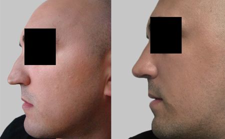 Nose surgery Belgrade - AestheticSerbia.com