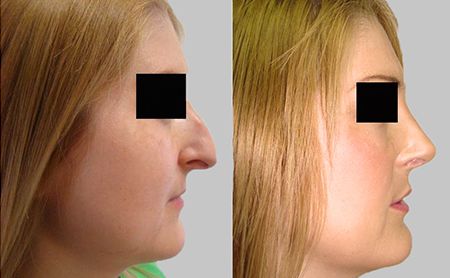 Rhinoplasty Serbia - AestheticSerbia.com