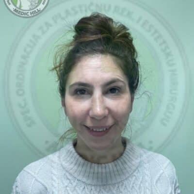 Before and after rhinoplasty – Medic Hill Hospital patient 1, front view
