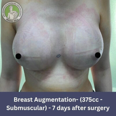 Breast augmentation Medic Hill pt6 submuscular 375cc profile pic
