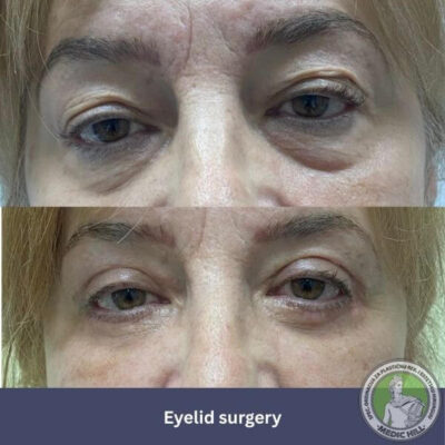 Medic Hill hospital blepharoplasty surgery before after photos - front view opened eyes