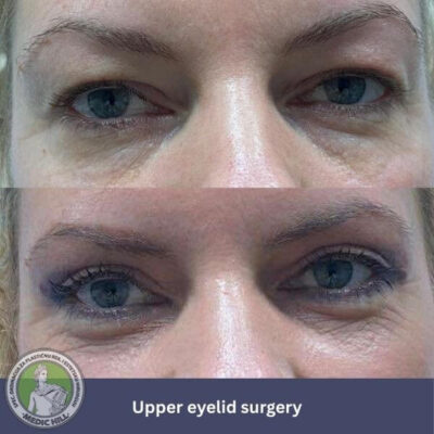 Medic Hill hospital Upper Eyelid surgery before after photos - front view
